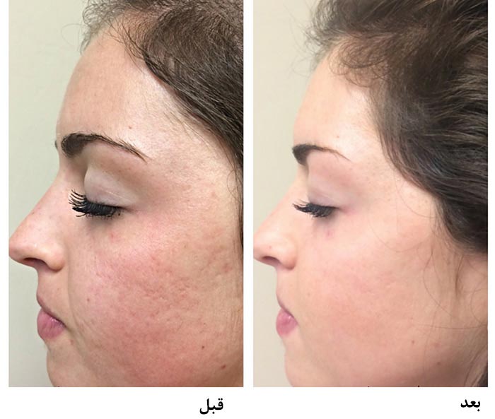 قبل و بعد از عمل لایه برداری پوست