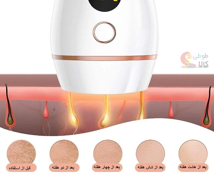 نحوه اثر گذاری دستگاه لیز مو خانگی