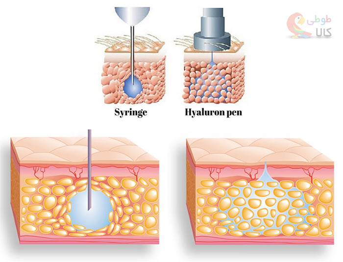 فرق روش هیالورون با تزریق ژل