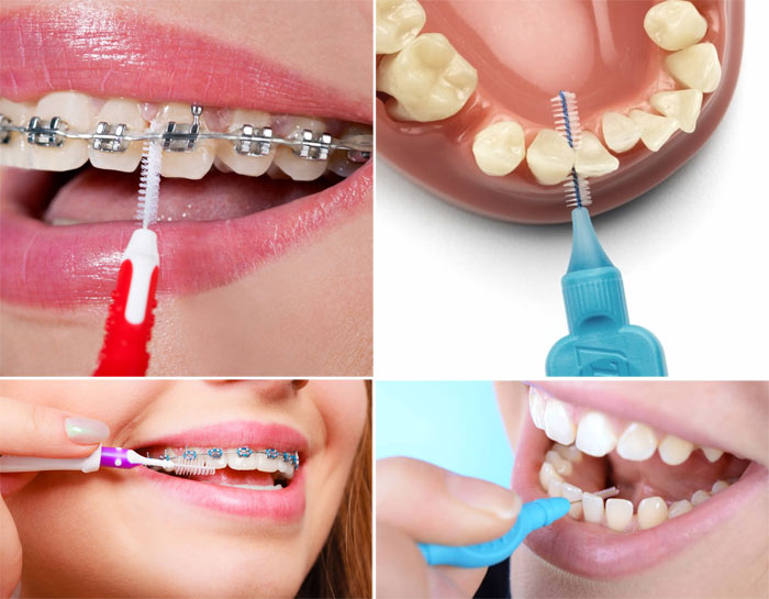 کاربرد مسواک بین دندانی