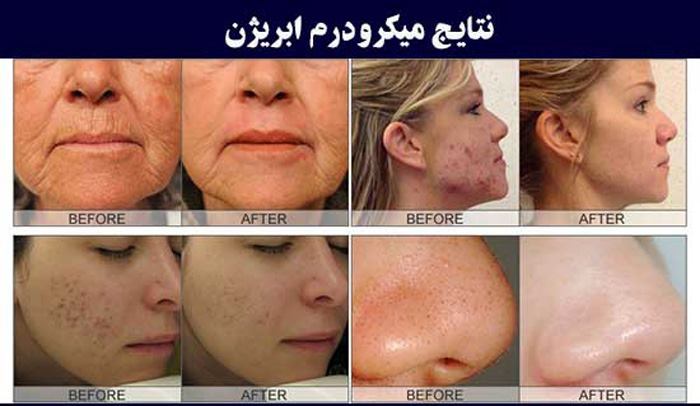 فواید میکرودرم ابریژن یا جوان سازی پوست