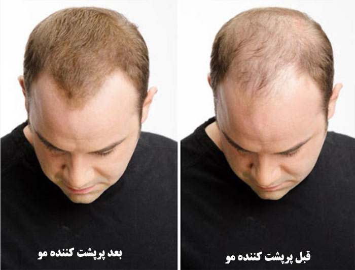 قبل و بعد استفاده از پرشت کننده مو