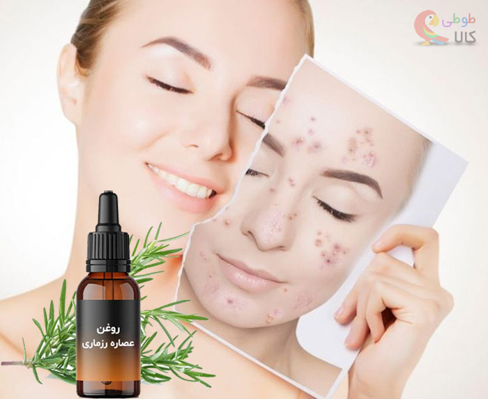 روغن رزماری برای رفع جوش صورت