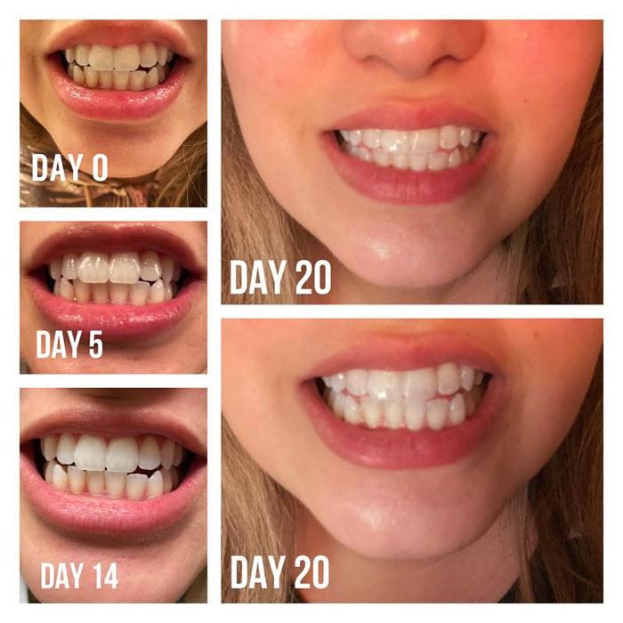 تاثیر قلم سفید کننده دندان