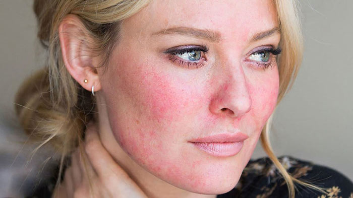 سوختگی پوست صورت