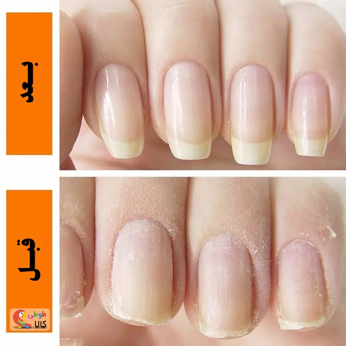 عکس بعد و قبل لمنیت ناخن