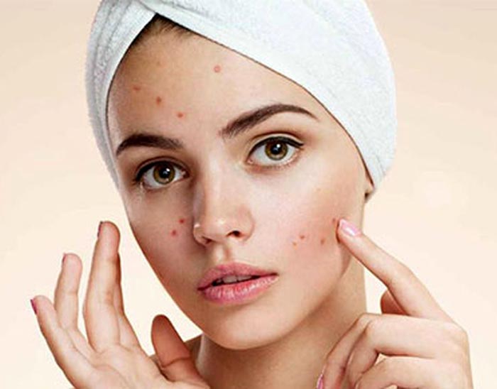 عکس جوش روی صورت