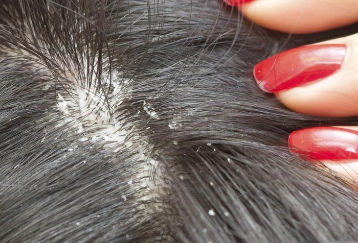 عفونت قارچی باعث ریزش مو