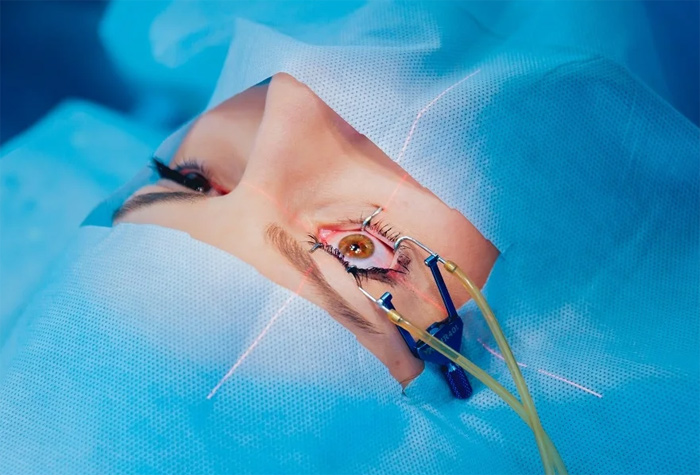 شستشوی لنز داخل چشم