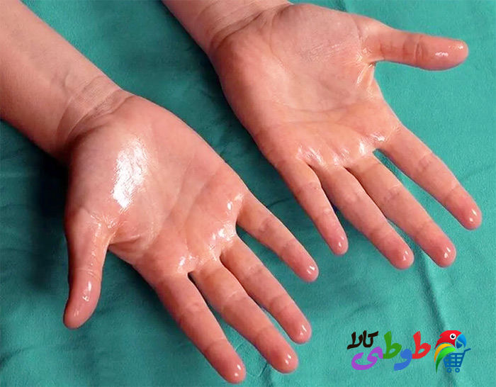 چرا کف دست ما عرق می کند