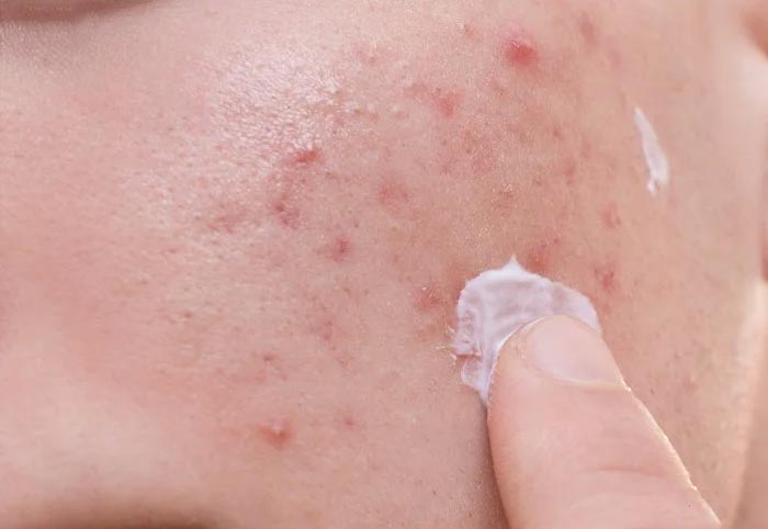 کرم ترمیم کننده زخم