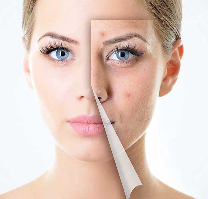 کرم و ژل ضد جوش صورت