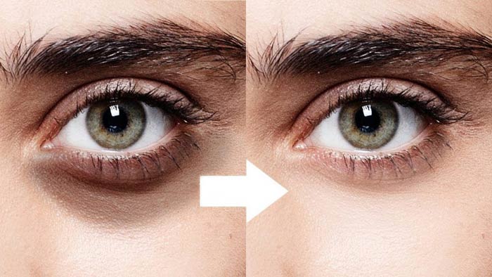 درمان تیرگی دور چشم