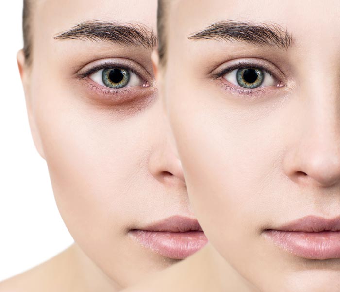 رفع سیاهی دور چشم