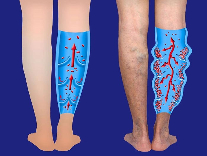 بیماری واریس