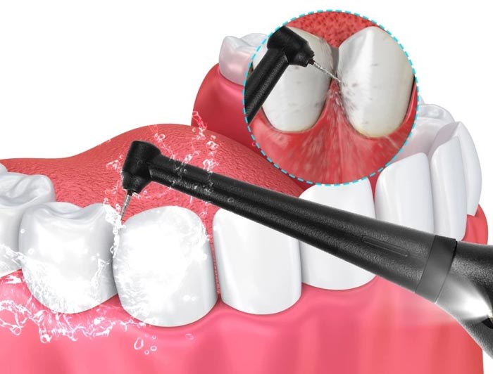 عکس جرم لای دندان ها