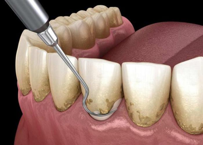 عکس جرم دندان