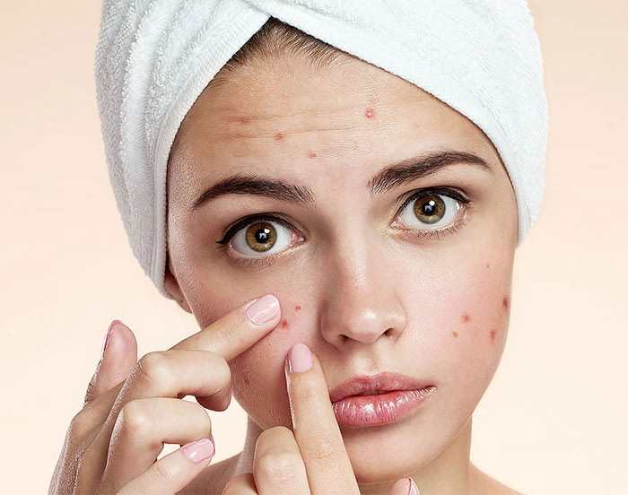 جوش صورت چیست