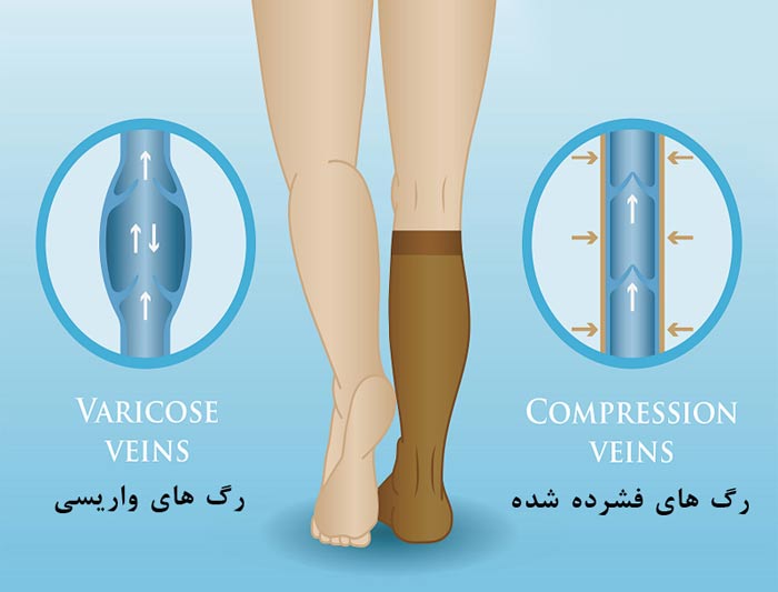 جوراب واریس