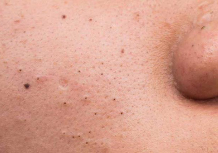 تصویر کومودون روی پوست صورت