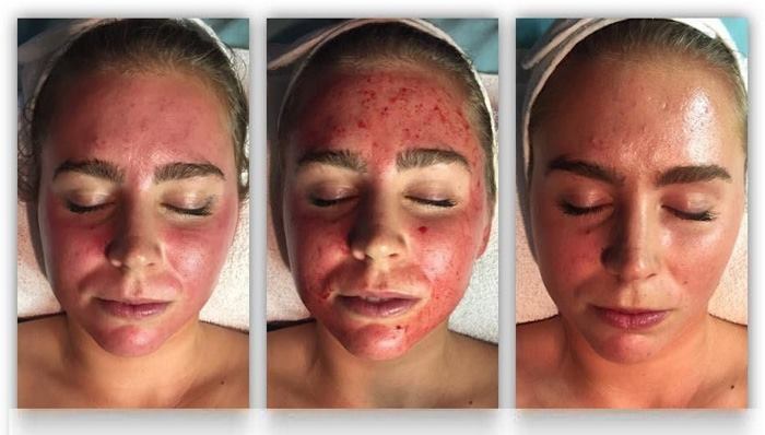 عوارض استفاده از دستگاه میکرونیدلینگ
