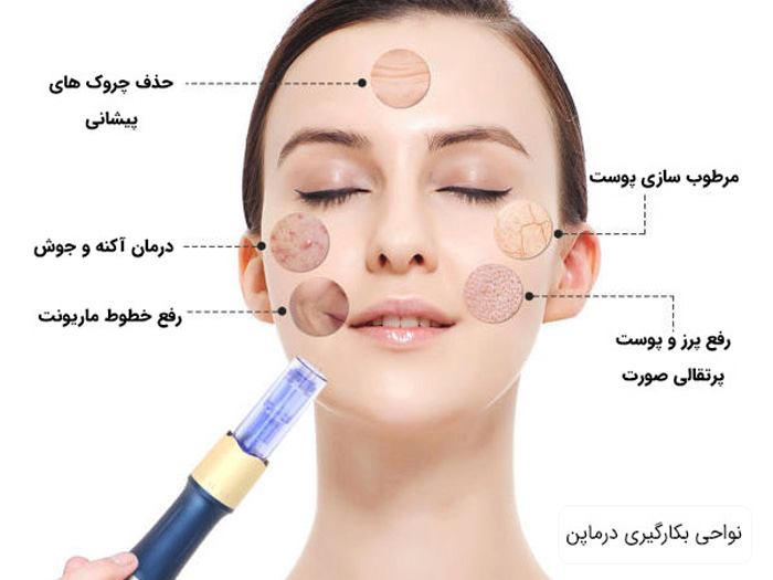 تاثیرات میکروندیلینگ