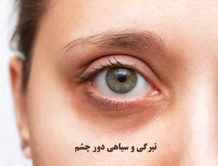 سیاهی دور چشم