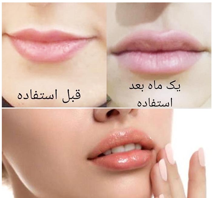 پروتز لب با روغن خراطین