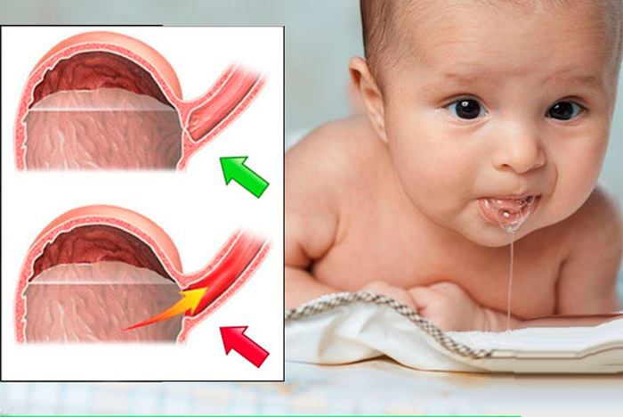 بیماری رفلاکس معده نوزاد