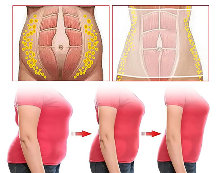 مزایای چسب لاغری