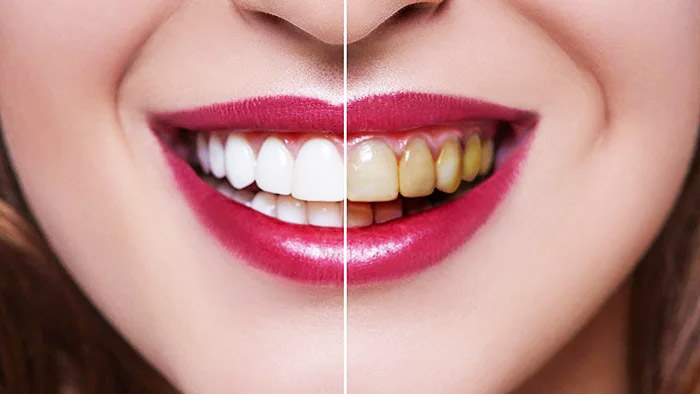 تاثیر خمیردندان سفید کننده