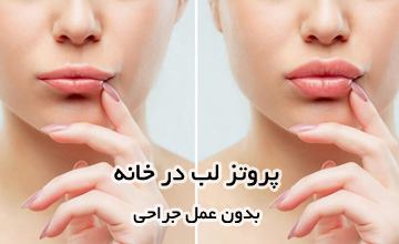 آموزش روشهای خانگی پروتز لب بدون عمل جراحی و تزریق