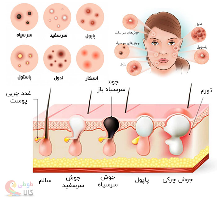 انواع جوش هاس صورت