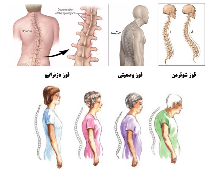 انواع قوز کمر