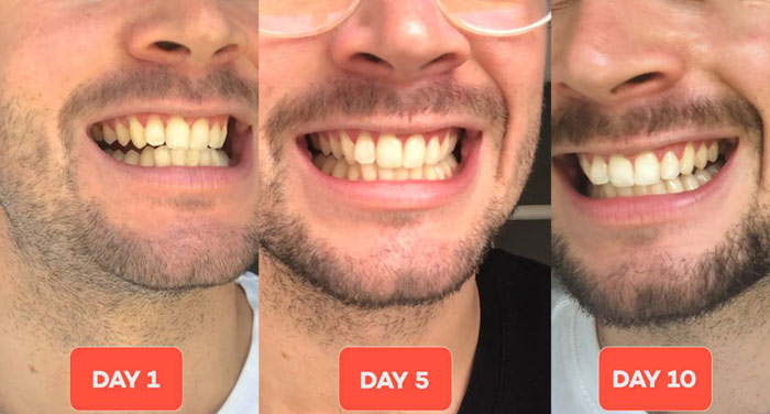 نحوه عملکرد خمیردندان سفید کننده