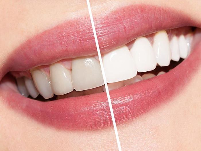 سفیدی دندان با پودر سفید کننده