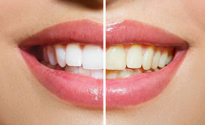 خمیردندان سفید کننده دندان